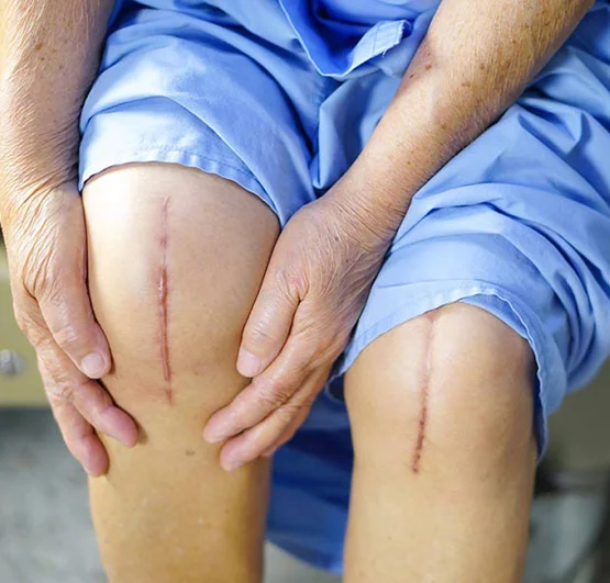 Knee Replacement